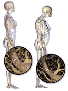 Osteoporoza simptomi