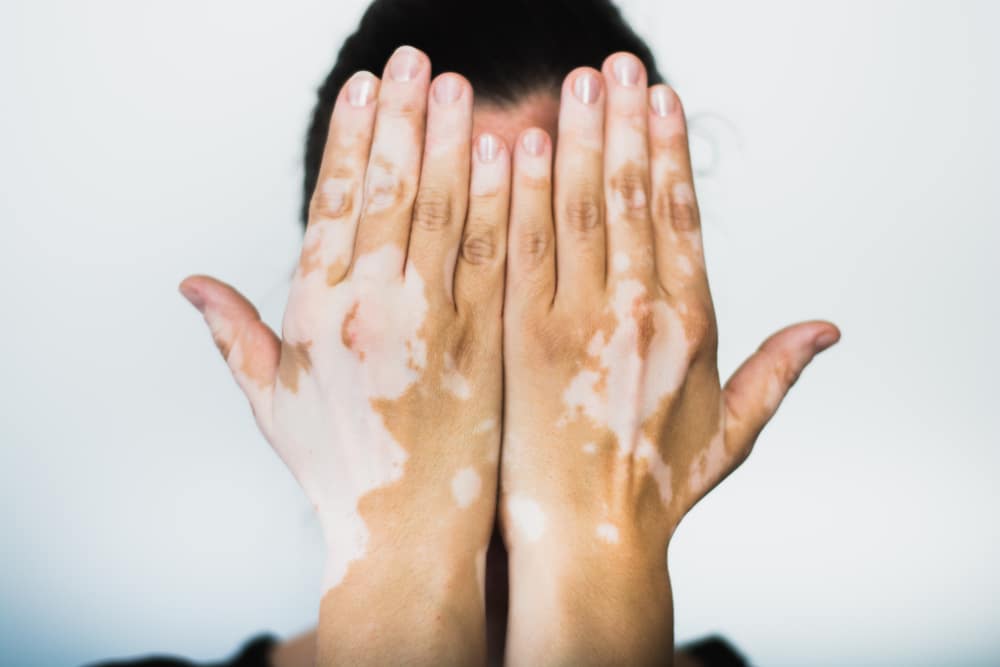 depigmentacija kože, vitiligo