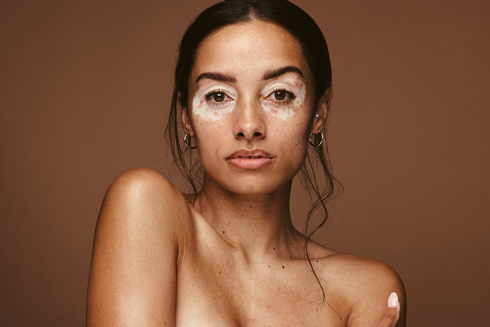 Vitiligo - potret žene