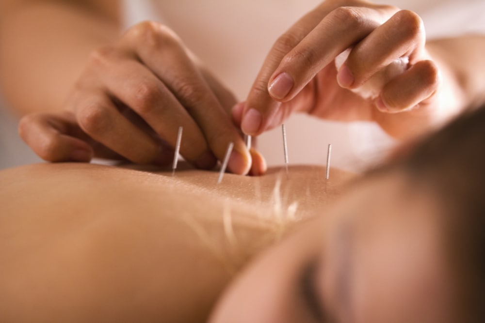 akupunktura u praksi