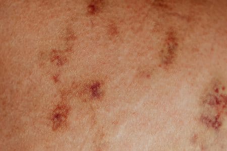 Prikaz crvenila na koži urokovan dermatitisom