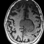 MRI snimka mozga koja prikazuje jasno vidljivu leziju u lijevoj hemisferi, okruženu zdravim moždanim tkivom.