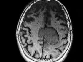 MRI snimka mozga koja prikazuje jasno vidljivu leziju u lijevoj hemisferi, okruženu zdravim moždanim tkivom.