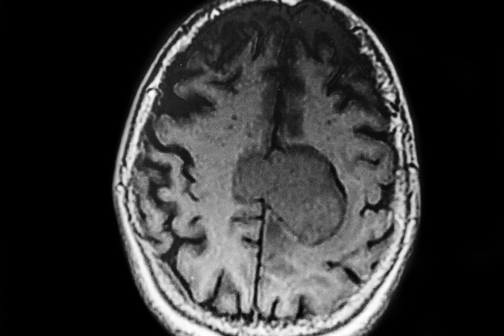 MRI snimka mozga koja prikazuje jasno vidljivu leziju u lijevoj hemisferi, okruženu zdravim moždanim tkivom.