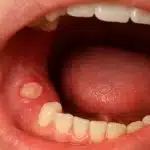 Krupni plan bolne afte na zubnom mesu unutar usne šupljine.