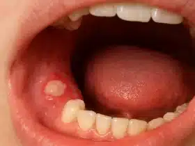 Krupni plan bolne afte na zubnom mesu unutar usne šupljine.