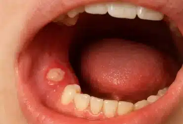 Krupni plan bolne afte na zubnom mesu unutar usne šupljine.