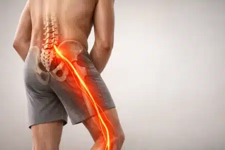 Realistična medicinska ilustracija ljudskog tijela s leđa i iz bočnog kuta, s naglašenim ishijadičnim živcem koji se proteže od donjeg dijela kralježnice kroz stražnjicu i niz nogu, vizualni prikaz išijasa i bolova u donjem dijelu leđa.