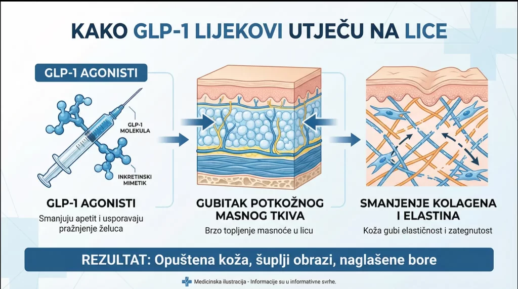 Infografika prikazuje kako GLP-1 agonisti mogu uzrokovati gubitak potkožne masti i smanjenje kolagena/elastina u licu, što dovodi do opuštene kože i šupljih obraza.
