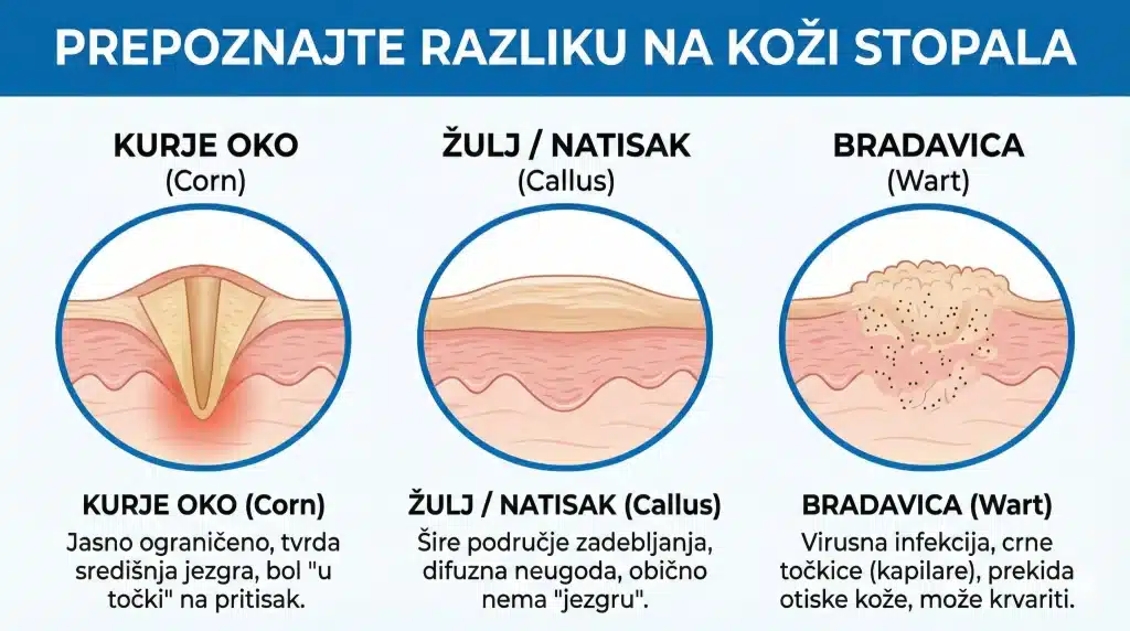 Infografika koja uspoređuje kurje oko, žulj/natisak i bradavicu na koži stopala, s prikazom razlika u strukturi (jezgra, difuzno zadebljanje, crne točkice).