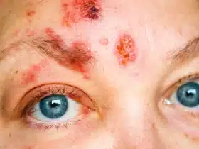 Krupni plan herpes zostera na čelu i oko oka s crvenim osipom, mjehurićima i krastama na koži lica